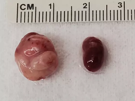tumor image